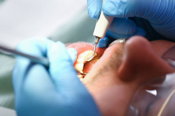 Best Emergency Root Canal Treatment in Lisbon, ND