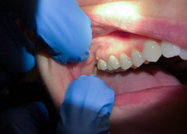 Best Emergency Wisdom Teeth Removal in Lisbon, ND
